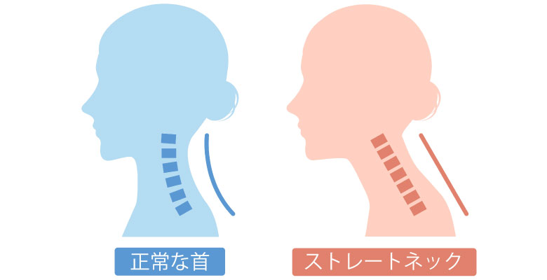 ストレートネック
