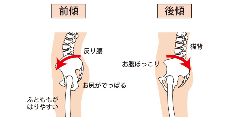 反り腰と猫背