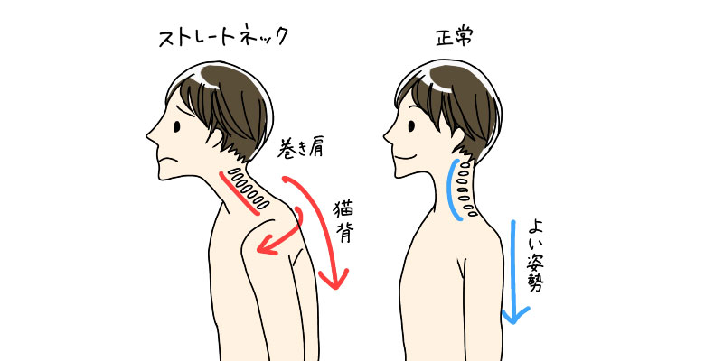 巻き肩、猫背、ストレートネック