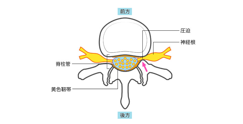 神経根型