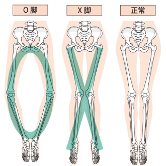 O脚・X脚