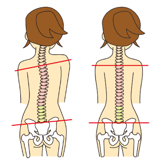 背骨のゆがみ